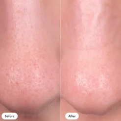 Hero Nose Patch