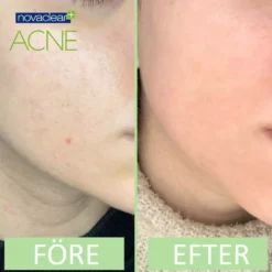 NovaclearAcne Kit - Facial Foam, Toner, Cream